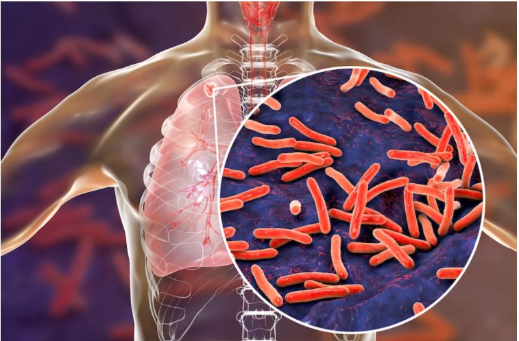 TB Testing Mandatory for Long-Term Travel from Zimbabwe to UK